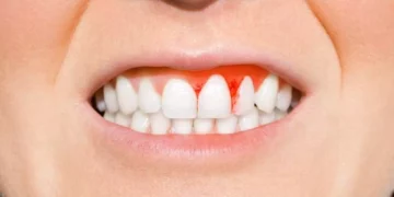 دراسة تكشف.. صحة الفم السيئة تزيد من خطر الإصابة بفشل القلب والسكتة الدماغية