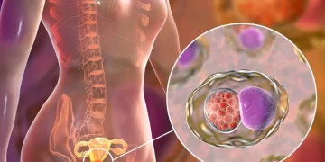 أكبر تقدم طبي منذ 25 عاماً.. علاج جديد لسرطان عنق الرحم يقلل الوفيات بنسبة 40%