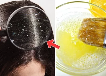 علاجات طبيعية لقشرة الشعر