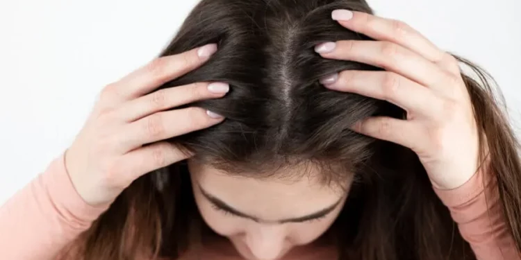 قشرة الشعر.. المشكلة التي تتفاقم شتاء 1 قشرة الشعر.. المشكلة التي تتفاقم شتاء