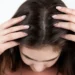 قشرة الشعر.. المشكلة التي تتفاقم شتاء 8 قشرة الشعر.. المشكلة التي تتفاقم شتاء