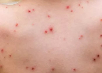 جدري القرود