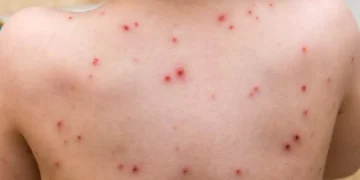 جدري القرود