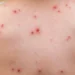 أمريكا تسجل أول إصابة بسلالة جديدة من جدري القرود 9 جدري القرود