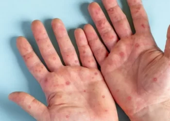 جدري القرود