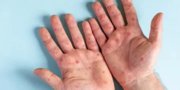 جدري القرود