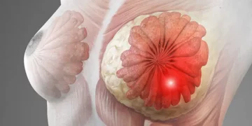 سرطان الثدي