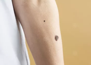 سرطان الجلد