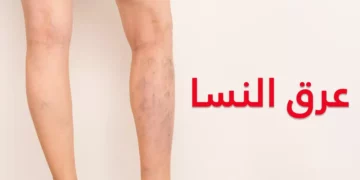 كيف أعلم أني مصاب بعرق النسا؟ كيفية التعامل مع عرق النسا.. الأعراض والأسباب وطرق العلاج الفعالة