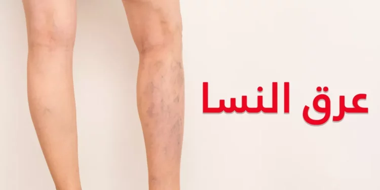 أضرار غير متوقعة لعرق النسا.. تصل إلى تلف الأعصاب  1 كيف أعلم أني مصاب بعرق النسا؟ كيفية التعامل مع عرق النسا.. الأعراض والأسباب وطرق العلاج الفعالة