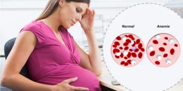 فقر الدم عند الحوامل