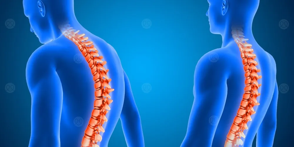 الحداب مشكلة خطيرة تهدد العمود الفقري.. أسبابه وطرق الوقاية 2 الحداب