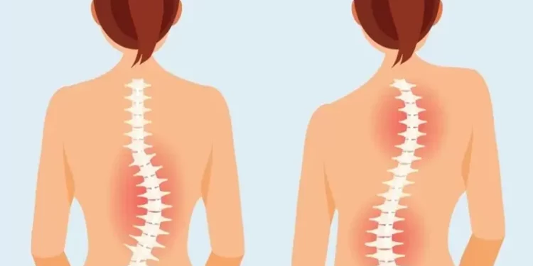 الحداب مشكلة خطيرة تهدد العمود الفقري.. أسبابه وطرق الوقاية 1 الحداب