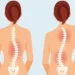 الحداب مشكلة خطيرة تهدد العمود الفقري.. أسبابه وطرق الوقاية 8 الحداب