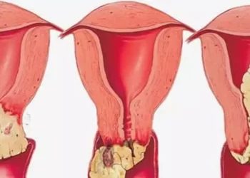 سرطان عنق الرحم