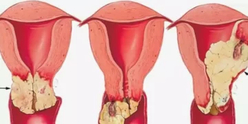 سرطان عنق الرحم