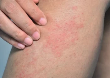 متلازمة الجلد المحمص