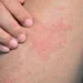 متلازمة الجلد المحمص.. دراسة تحذّر من مخاطر استخدام وسائد الماء الساخن 8 متلازمة الجلد المحمص