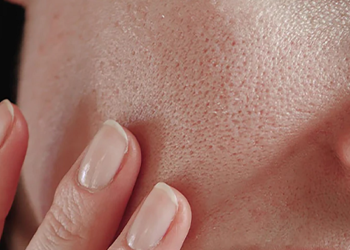 علاج المسامات الواسعة