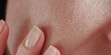 علاج المسامات الواسعة