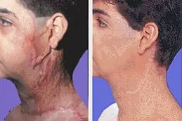 عمليات تجميل الحروق قبل وبعد