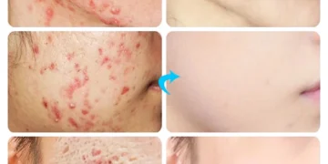 كريم لإزالة حب الشباب