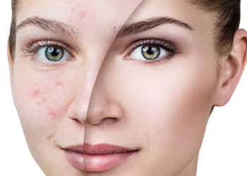 علاج آثار حب الشباب 2025