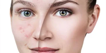 علاج آثار حب الشباب 2025