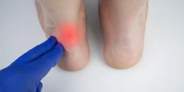 التهاب وتر أخيل