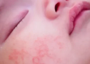 حساسية الطعام عند الأطفال