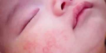 حساسية الطعام عند الأطفال