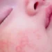 حساسية الطعام عند الأطفال.. 5 أعراض «نوضحها» احذريها لصحة طفلك 8 حساسية الطعام عند الأطفال