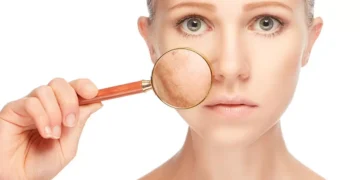 نضارة البشرة بعد الولادة