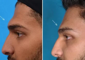 شد الجبهة بالمنظار سعر