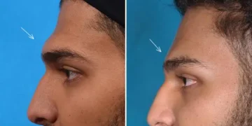 شد الجبهة بالمنظار سعر