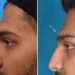 عملية شد الجبهة بالمنظار سعر مناسب ونتيجة مضمونة.. وداعًا للخطوط والترهلات! 9 شد الجبهة بالمنظار سعر