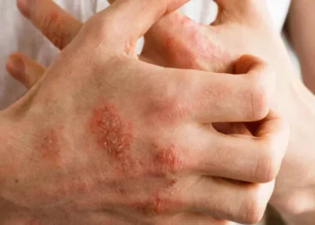 كريم الأكزيما