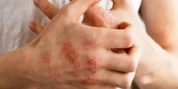 كريم الأكزيما