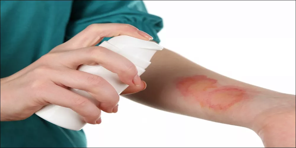 علاج تجميل الحروق