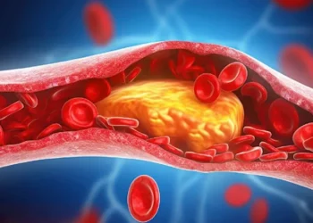 أعراض ارتفاع الكوليسترول عند النساء