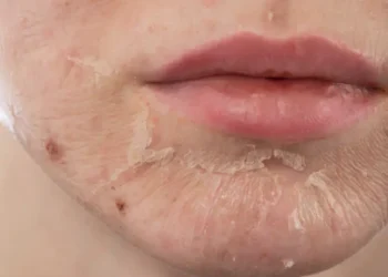 التقشير البارد للوجه.. سر نضارة البشرة