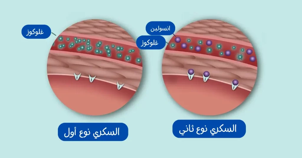 الفرق بين السكر النوع الأول والثاني