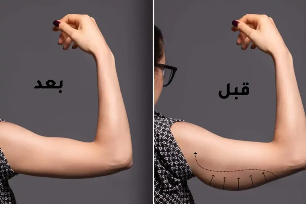 شد ترهلات الذراعين 