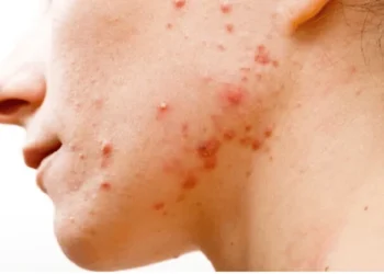 كيفية إزالة حب الشباب للتمتع ببشرة صافية ومشرقة