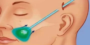 كيف يعمل شد الوجه بالمنظار على استعادة شبابك مرة أخرى؟