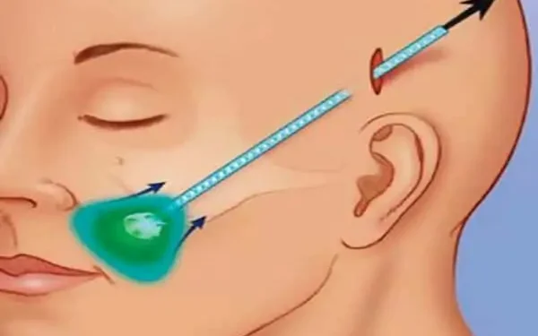 كيف يعمل شد الوجه بالمنظار على استعادة شبابك مرة أخرى؟ 1 كيف يعمل شد الوجه بالمنظار على استعادة شبابك مرة أخرى؟