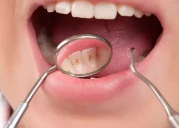 علاج تسوس الأسنان.. أهم الاكتشافات الطبية لصحة فمك بدون ألم