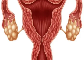 ما هو تكيس المبايض وكيفية علاجه والشفاء منه؟