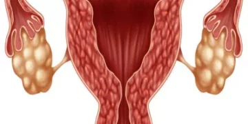 ما هو تكيس المبايض وكيفية علاجه والشفاء منه؟ 2 ما هو تكيس المبايض وكيفية علاجه والشفاء منه؟