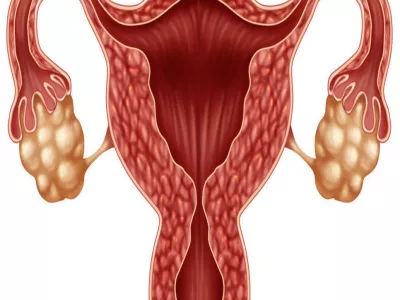 ما هو تكيس المبايض وكيفية علاجه والشفاء منه؟ 1 ما هو تكيس المبايض وكيفية علاجه والشفاء منه؟